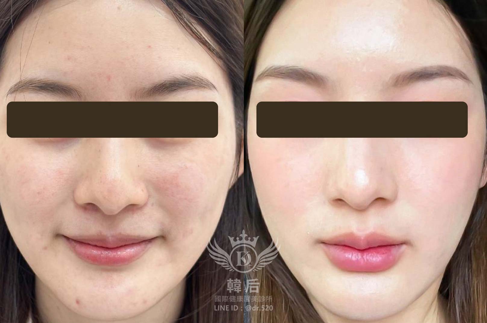 香奈兒針NCTF 135HA,小粉瓶,素人真實案例,韓后醫美