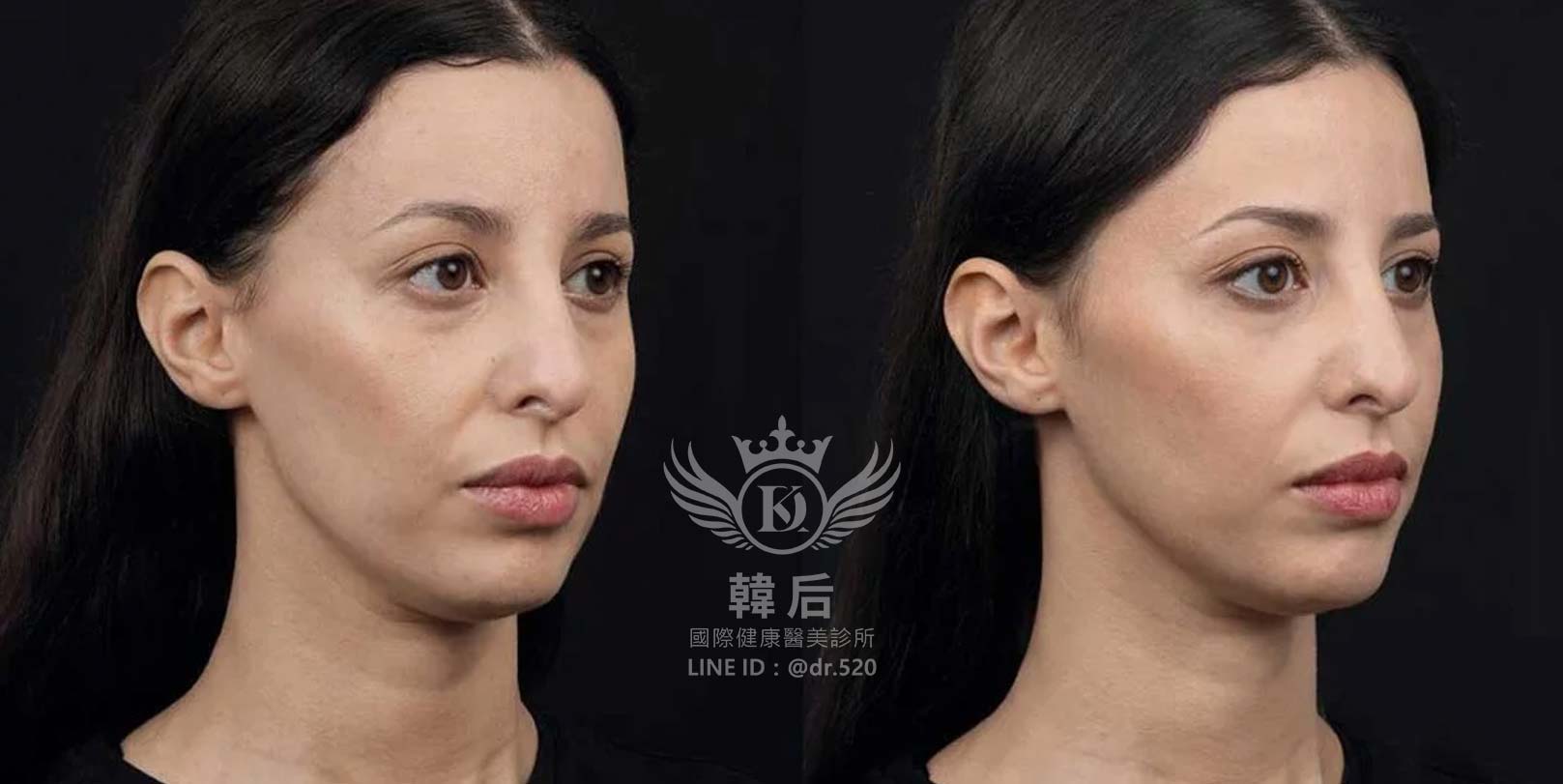 香奈兒針NCTF 135HA,小粉瓶,素人真實案例,韓后醫美