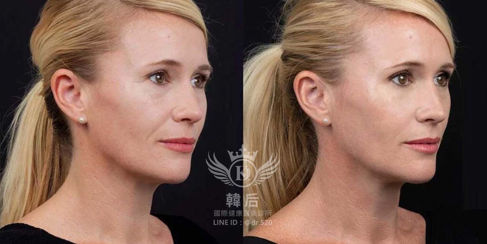 香奈兒針NCTF 135HA,小粉瓶,素人真實案例,韓后醫美