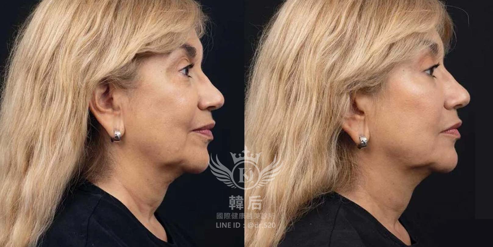 香奈兒針NCTF 135HA,小粉瓶,素人真實案例,韓后醫美