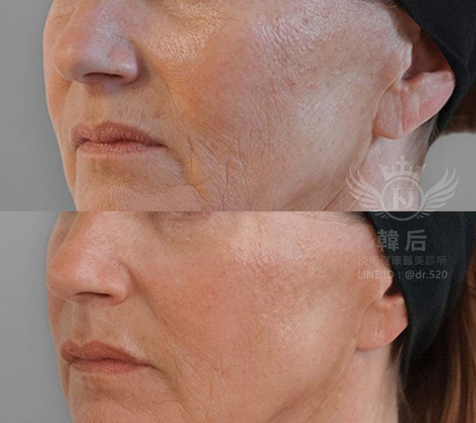 韓后醫美,ELLANSÉ,洢蓮絲,填補,淚溝,法令紋,蘋果肌,素人真實案例