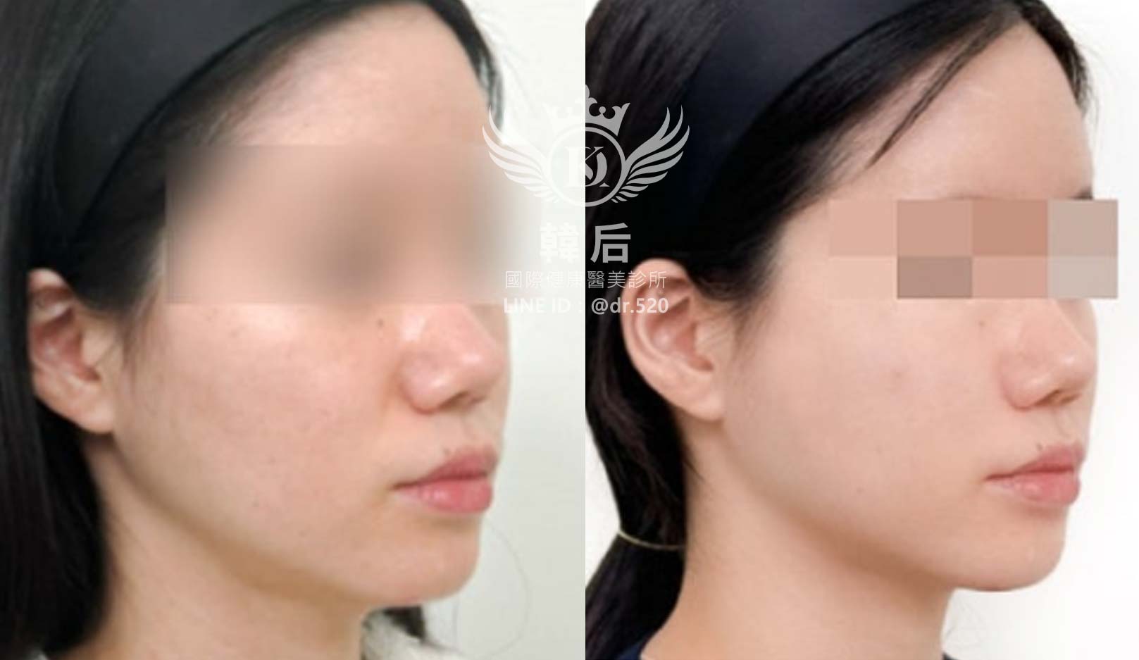 韓后醫美,ELLANSÉ,洢蓮絲,填補,淚溝,法令紋,蘋果肌,素人真實案例