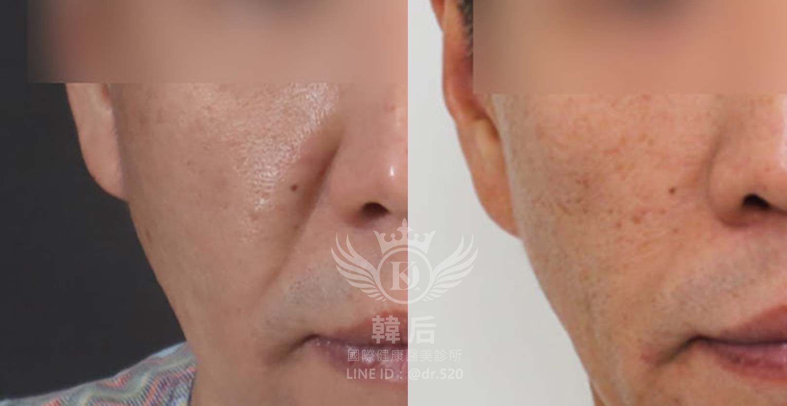 韓后醫美,ELLANSÉ,洢蓮絲,填補,淚溝,法令紋,蘋果肌,素人真實案例