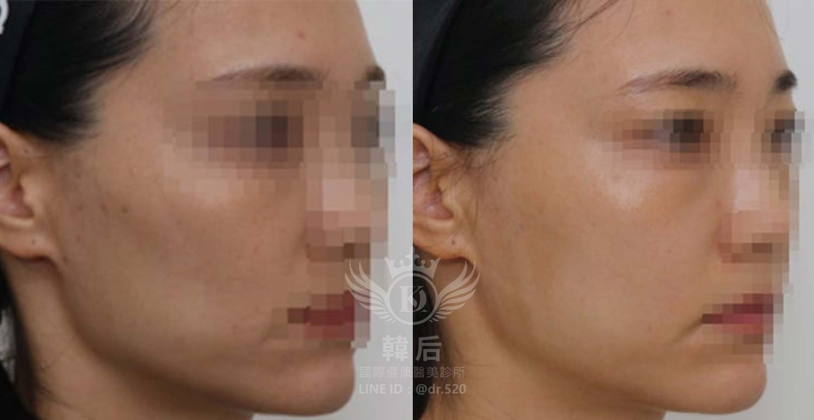 韓后醫美,ELLANSÉ,洢蓮絲,填補,淚溝,法令紋,蘋果肌,素人真實案例