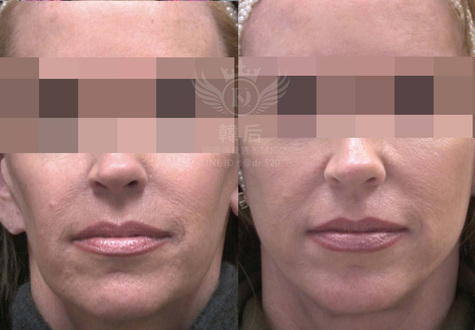 韓后醫美,ELLANSÉ,洢蓮絲,填補,淚溝,法令紋,蘋果肌,素人真實案例