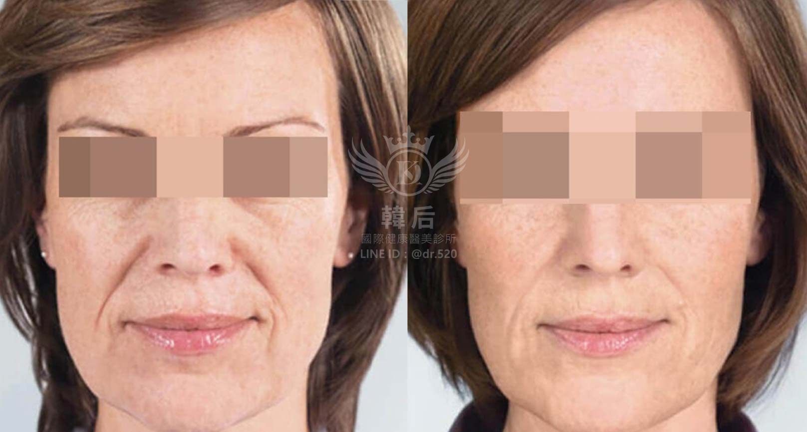 韓后醫美,ELLANSÉ,洢蓮絲,填補,淚溝,法令紋,蘋果肌,素人真實案例
