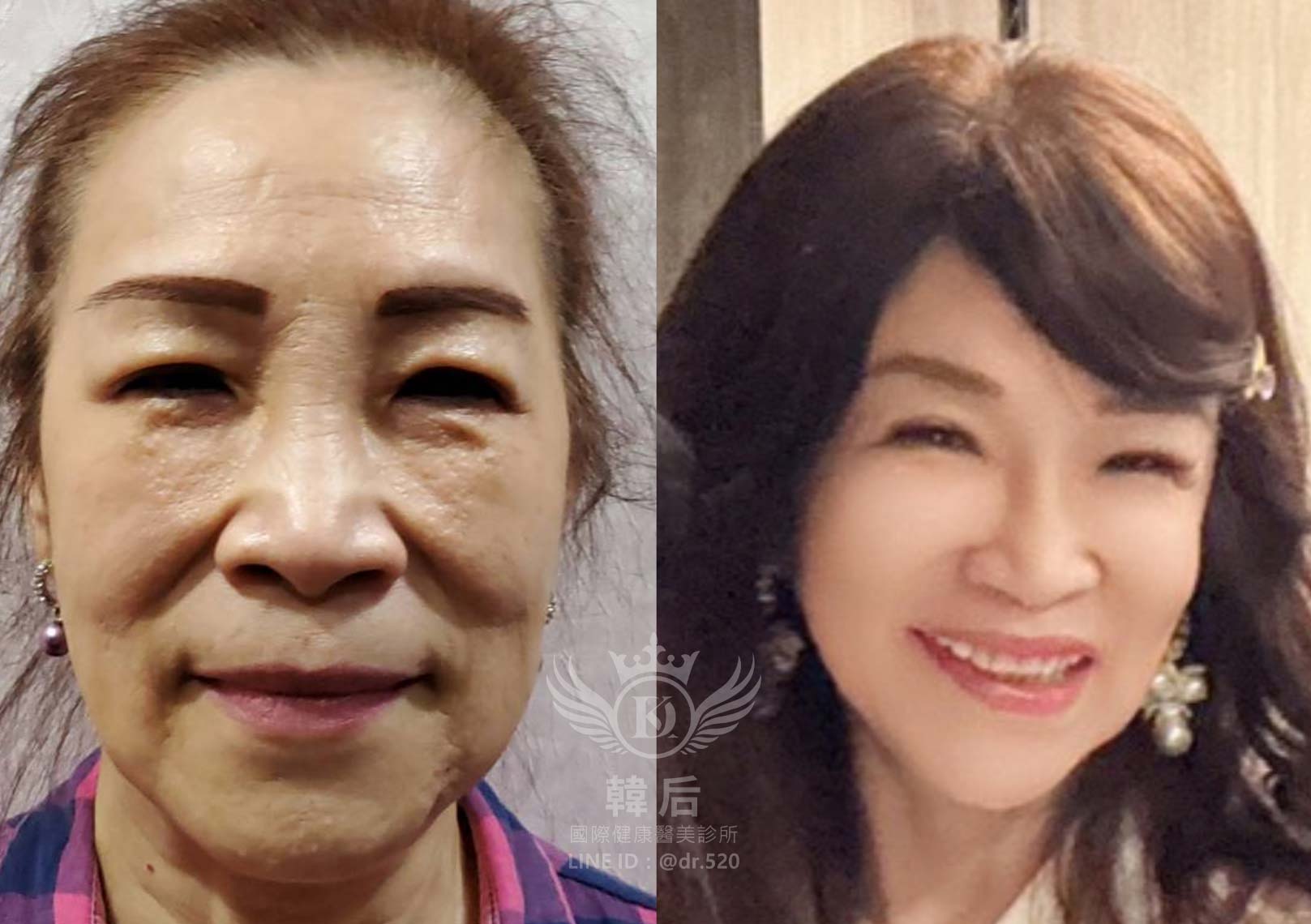 韓后醫美,ELLANSÉ,洢蓮絲,填補,淚溝,法令紋,蘋果肌,素人真實案例