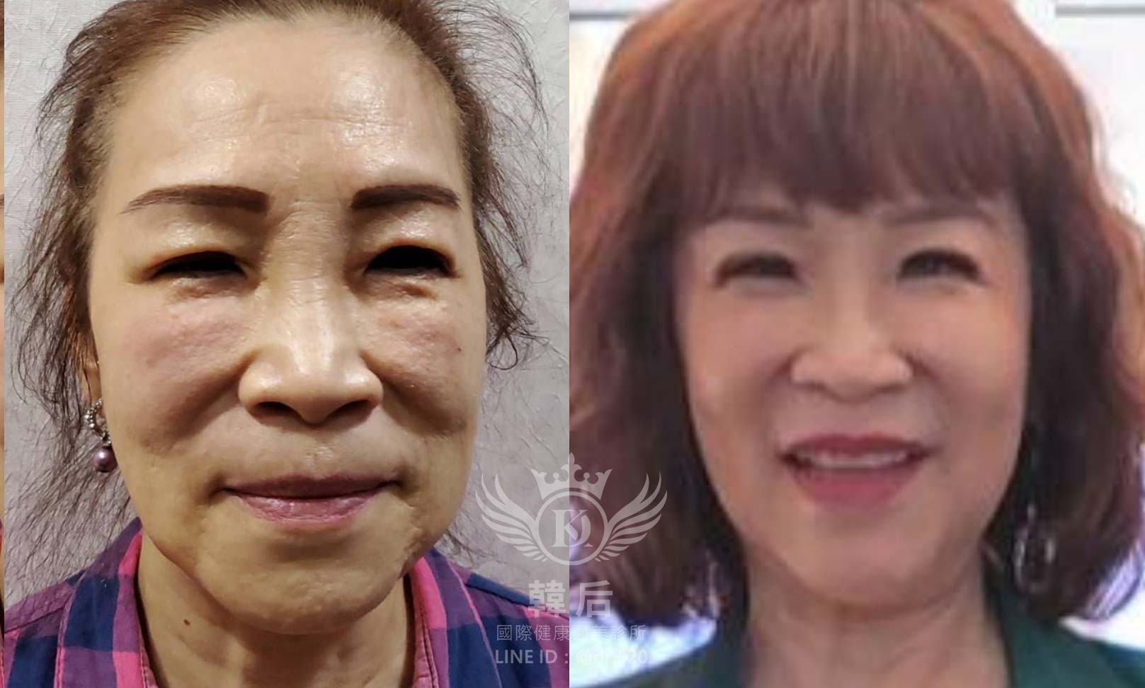 韓后醫美,ELLANSÉ,洢蓮絲,填補,淚溝,法令紋,蘋果肌,素人真實案例