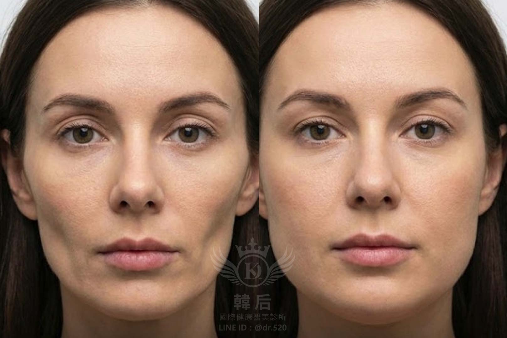 韓后醫美,ELLANSÉ,洢蓮絲,填補,淚溝,法令紋,蘋果肌,素人真實案例