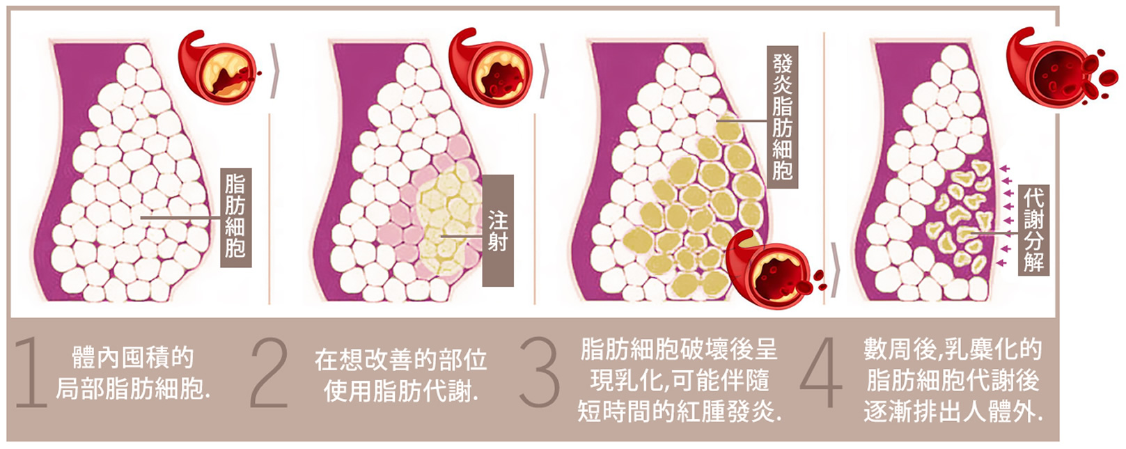 韓后醫美 韓式脂肪代謝 肝得健 Lipodissolve lnjection