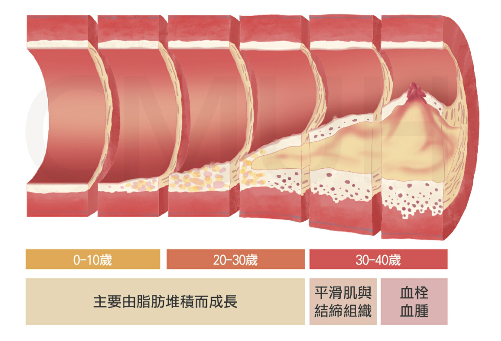 韓后醫美 脂肪長期囤積在血管內壁上，久而久之即造成動脈硬化，可能會發生血管阻塞，引發心臟疾病如心絞痛或心肌梗塞，或是腦血管病變如腦梗塞或是腦出血。