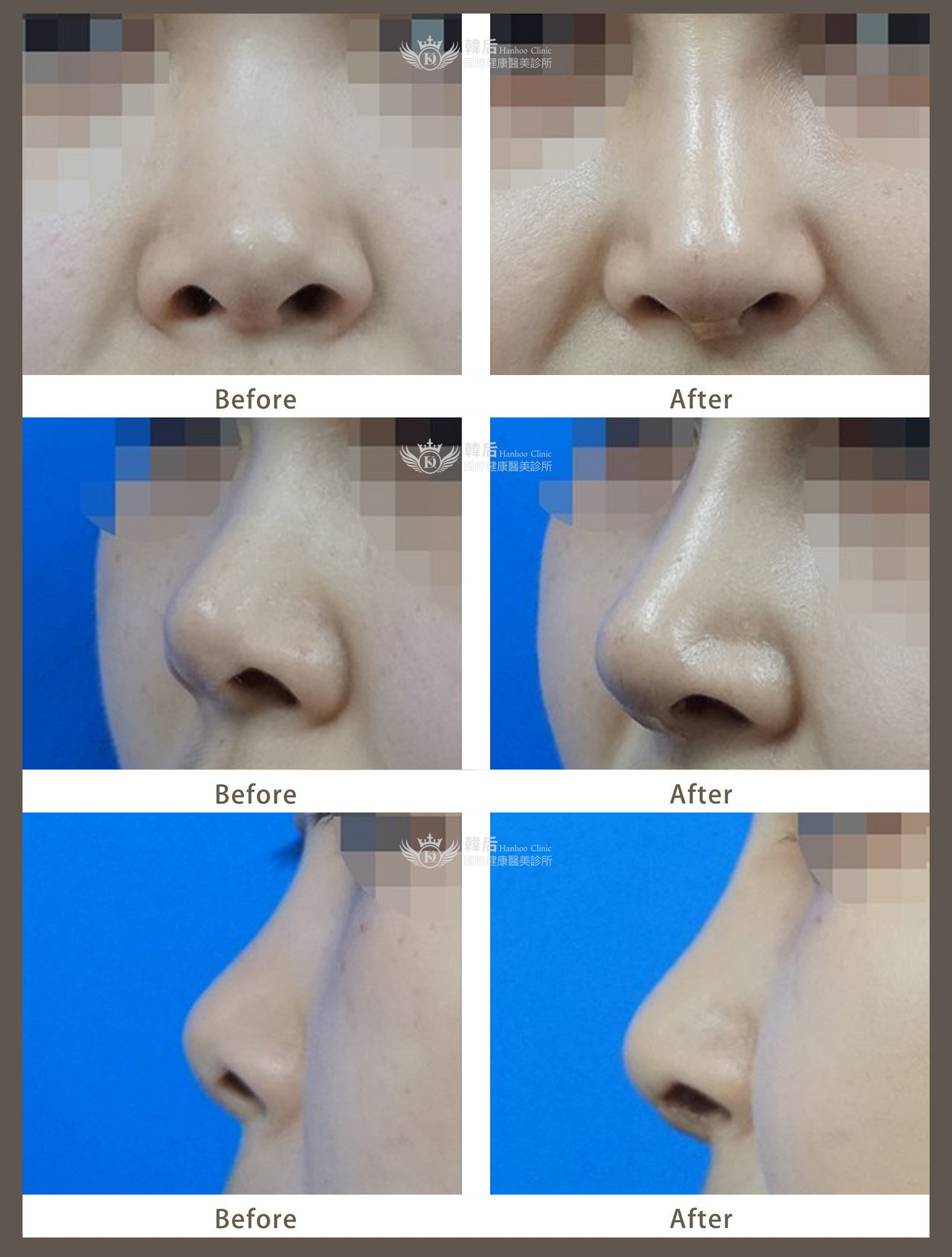 韓后醫美 韓式多段式 /複合式隆鼻 真實案例