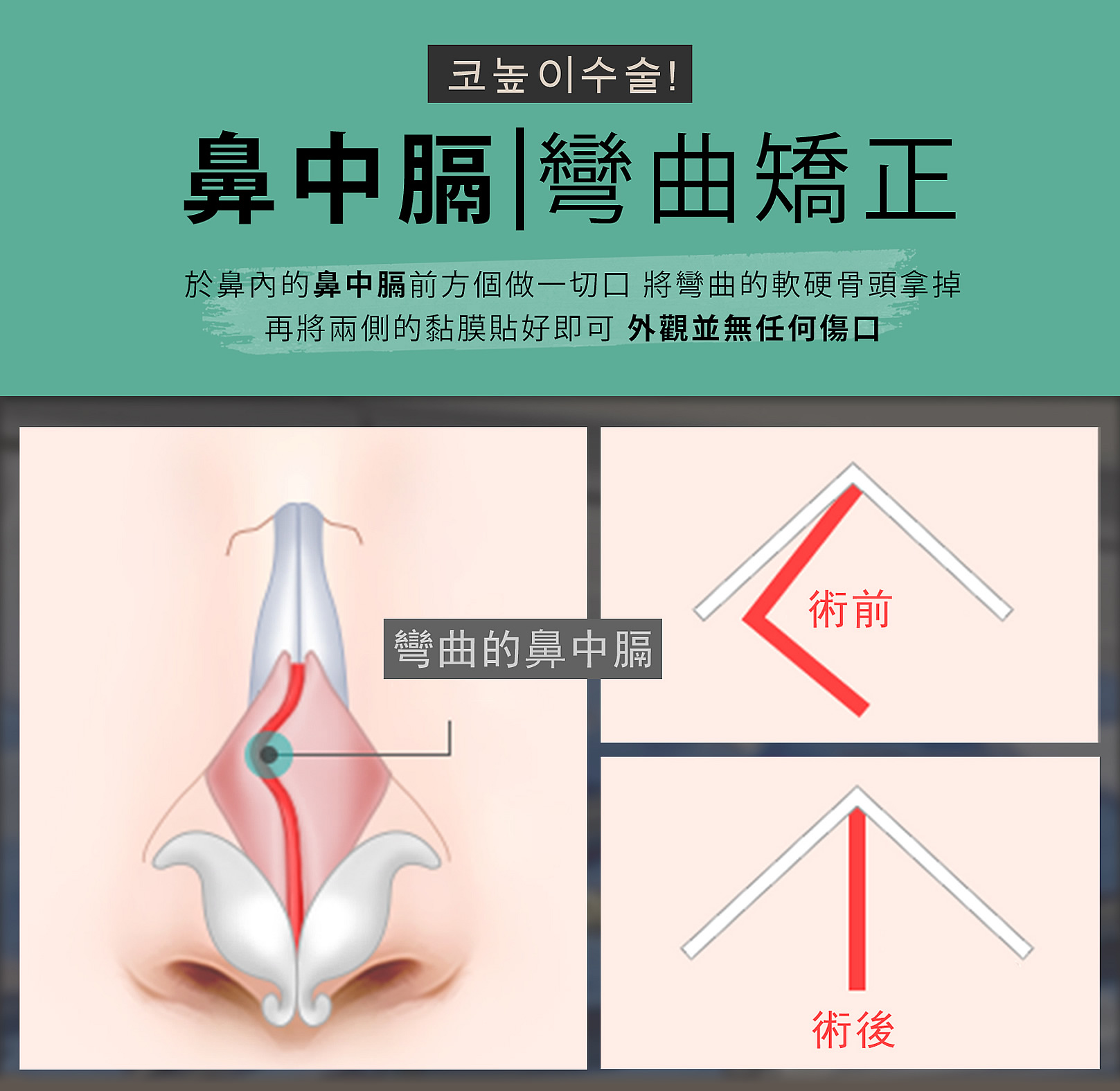 韓后醫美 特殊鼻部矯正 鼻中膈彎曲