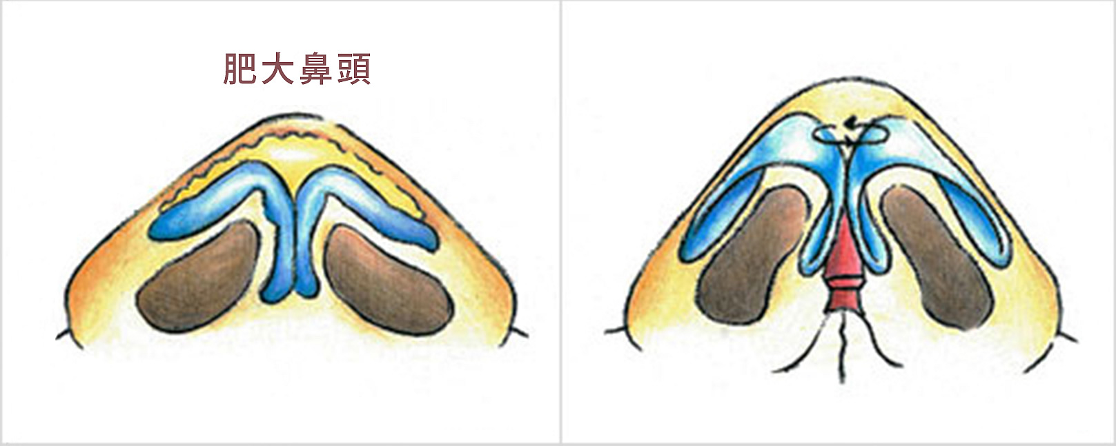 韓后醫美 特殊鼻部矯正 鼻尖縮小