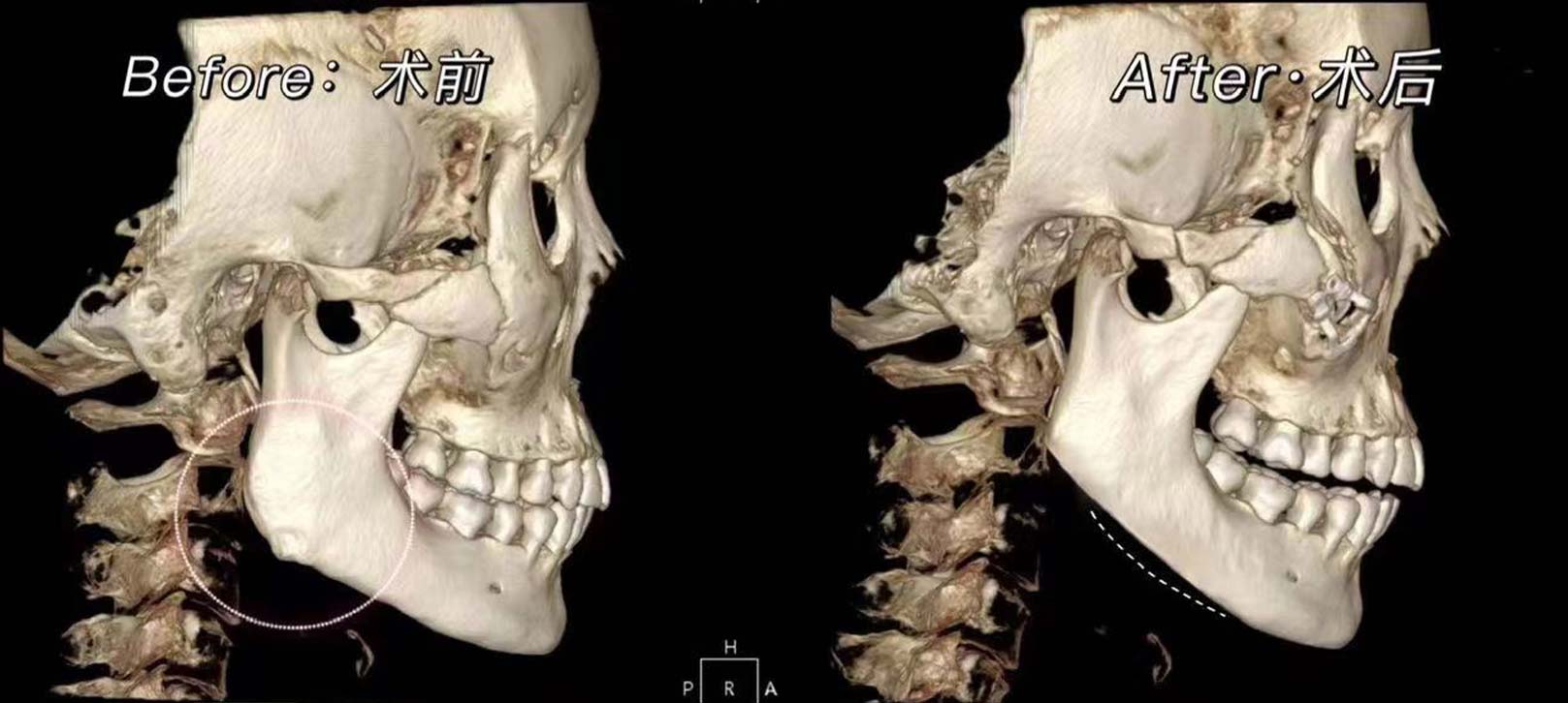 韓后醫美,韓國削骨權威 金一秀院長 成功的削骨手術