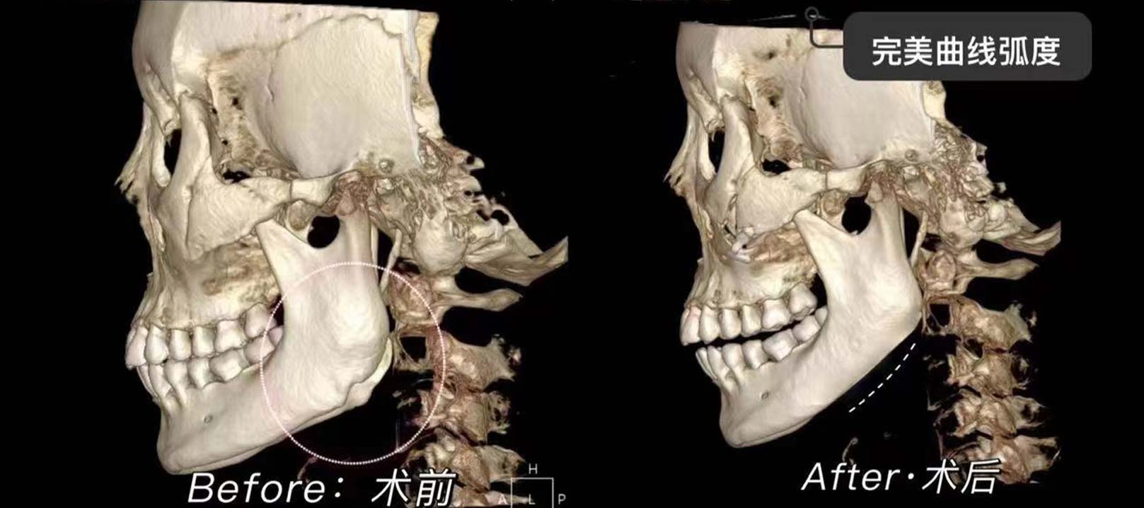 韓后醫美,韓國削骨權威 金一秀院長 成功的削骨手術