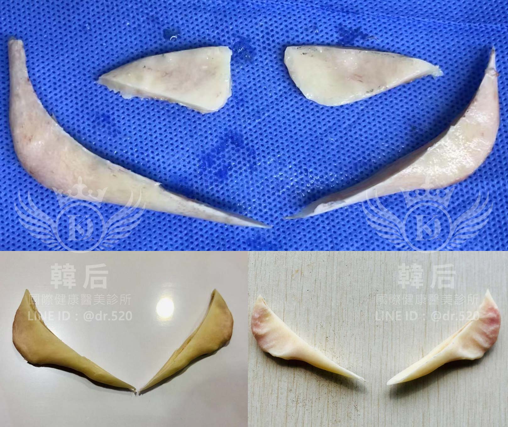 削骨醫師準備高度品質與安全的器械，確保每一張削骨後的臉形脫胎換骨