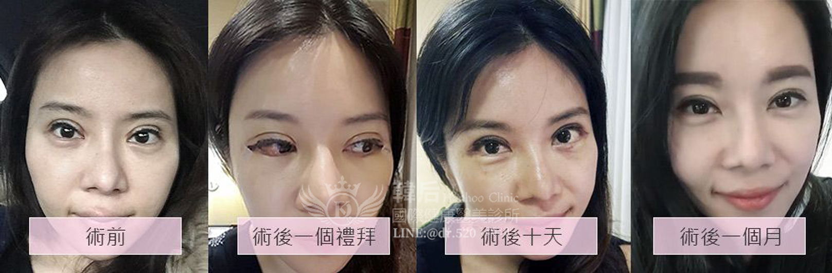韓后醫美孔娜娜執行長重修雙眼皮,重修見證