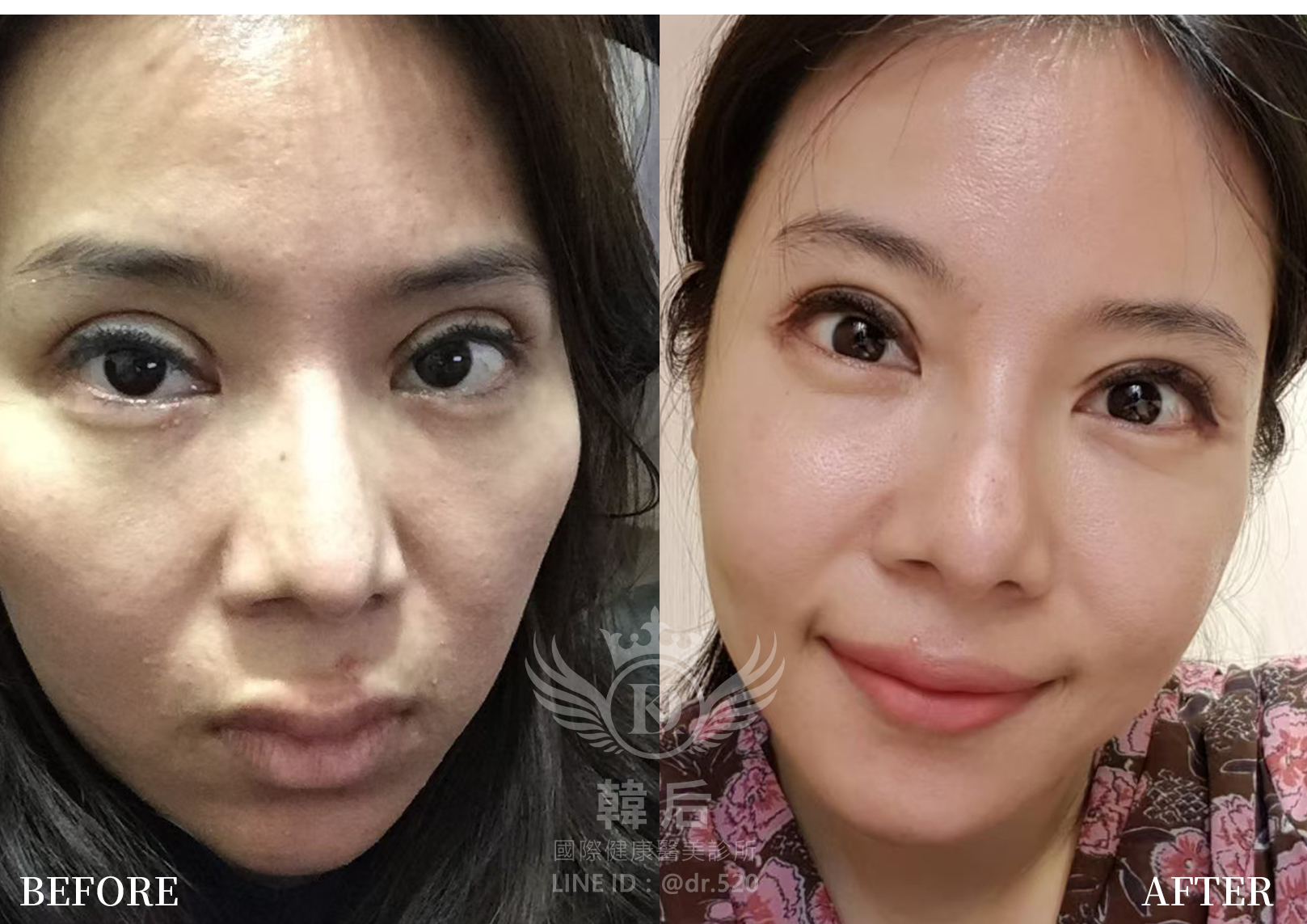韓后醫美孔娜娜執行長重修雙眼皮,重修見證