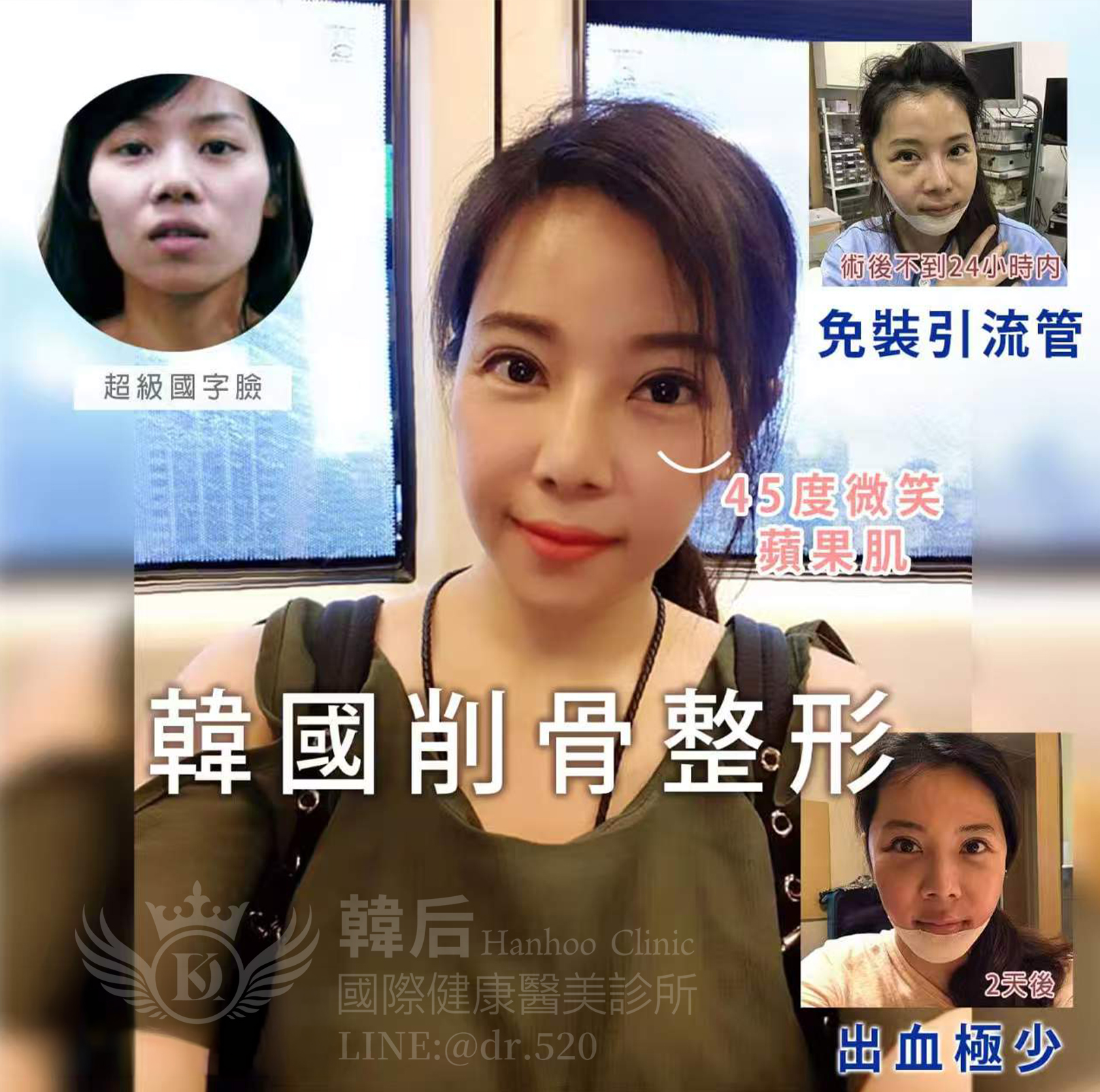 韓后醫美,韓后執行長,孔娜娜,NANA,兇兇苦命臉,台版ANGELABABY,韓國削骨,顴骨內推,下巴T截骨
