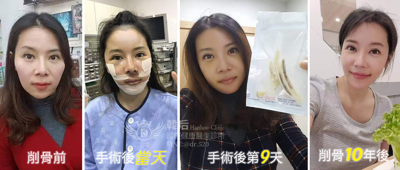 韓后醫美,韓后執行長,孔娜娜,NANA,兇兇苦命臉,台版ANGELABABY,韓國削骨,顴骨內推,下巴T截骨