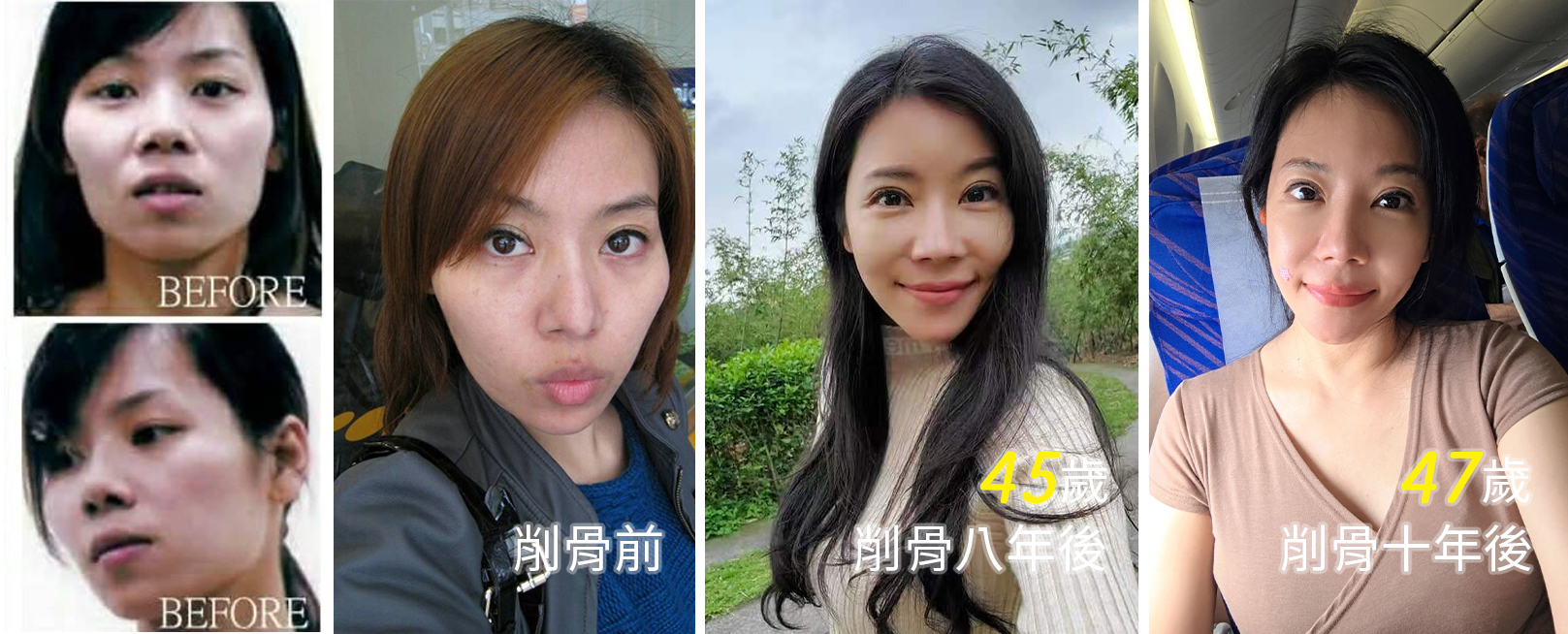 韓后醫美,韓后執行長,孔娜娜,NANA,兇兇苦命臉,台版ANGELABABY,韓國削骨,顴骨內推,下巴T截骨