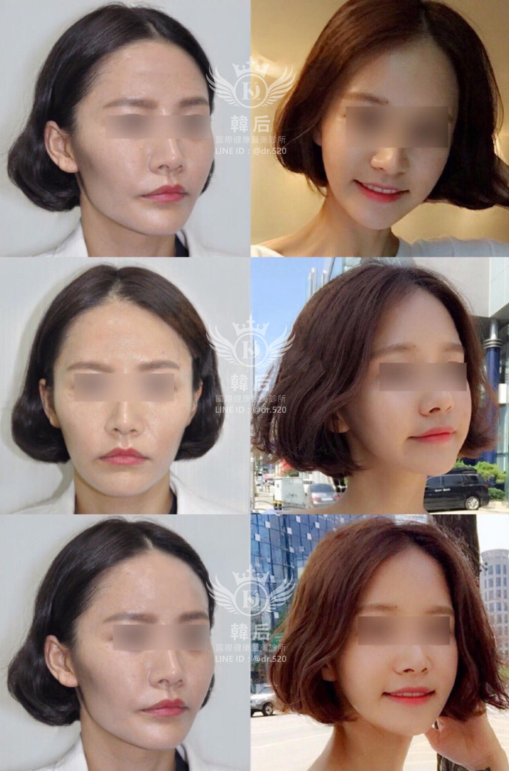 削骨,磨骨,磨骨手術,磨骨三件套,顴骨內推,台灣,上海,韓國,韓國削骨權威,金一秀院長,韓后醫美削骨案例
