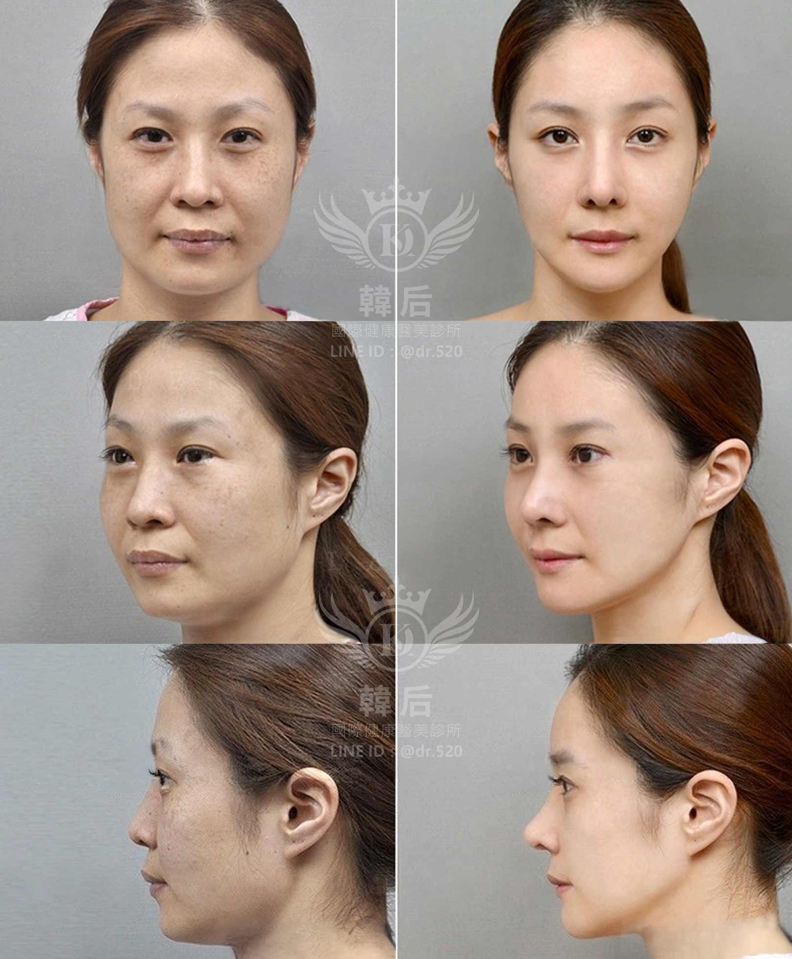 削骨,磨骨,磨骨手術,磨骨三件套,顴骨內推,台灣,上海,韓國,韓國削骨權威,金一秀院長,韓后醫美削骨案例