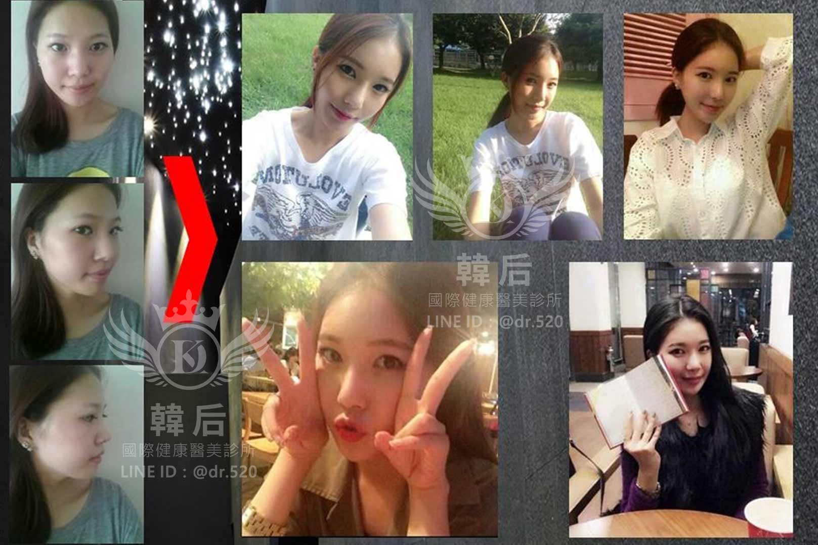 削骨,磨骨,磨骨手術,磨骨三件套,顴骨內推,台灣,上海,韓國,韓國削骨權威,金一秀院長,韓后醫美削骨案例