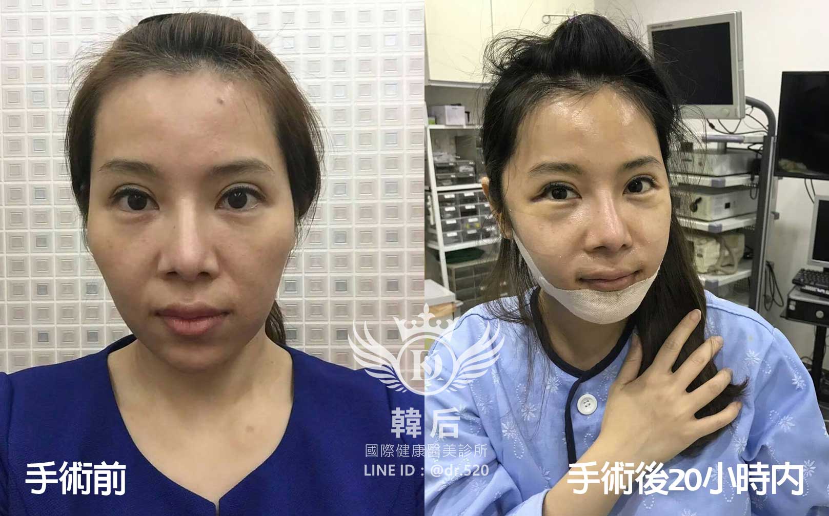 削骨,韓國削骨,上海削骨,磨骨,削骨手術,削骨十年,臉型雕塑,醫美執行長,醫美日常