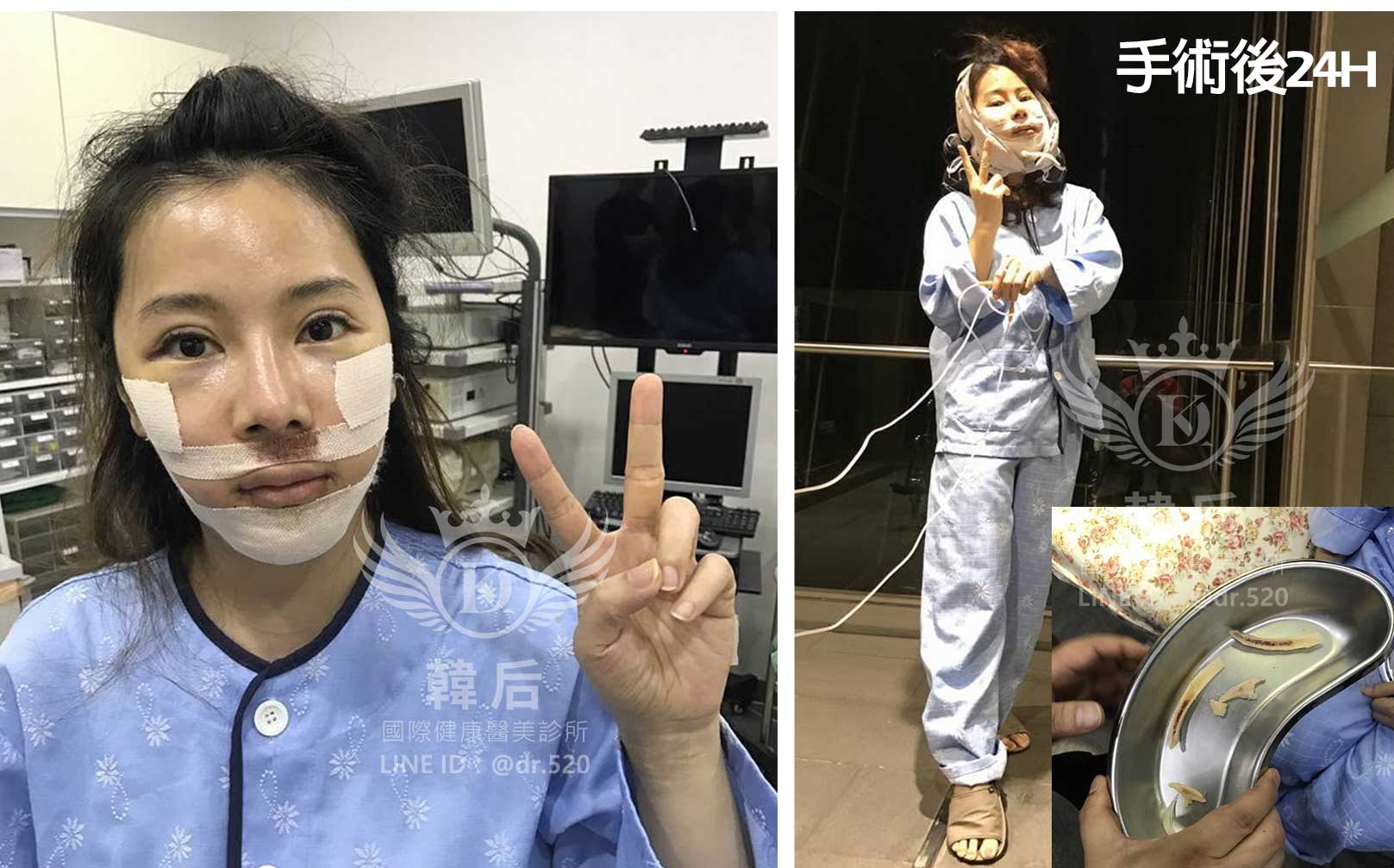 削骨,韓國削骨,上海削骨,磨骨,削骨手術,削骨十年,臉型雕塑,醫美執行長,醫美日常