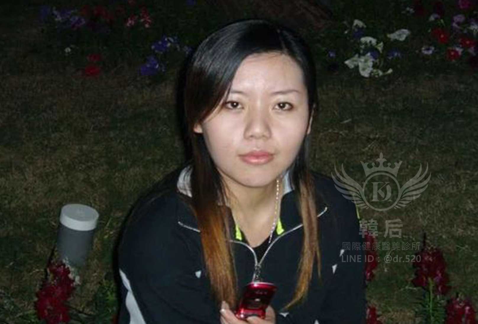 削骨,韓國削骨,上海削骨,磨骨,削骨手術,削骨十年,臉型雕塑,范冰冰,范爺,醫美,醫美日常
