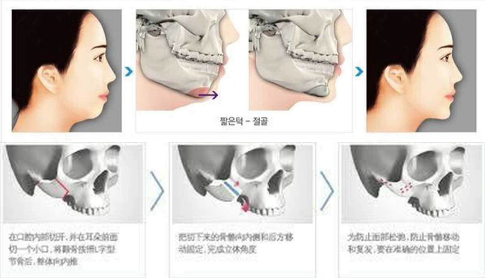 削骨,韓國削骨,上海削骨,磨骨,削骨手術,削骨十年,臉型雕塑,范冰冰,范爺,醫美,醫美日常
