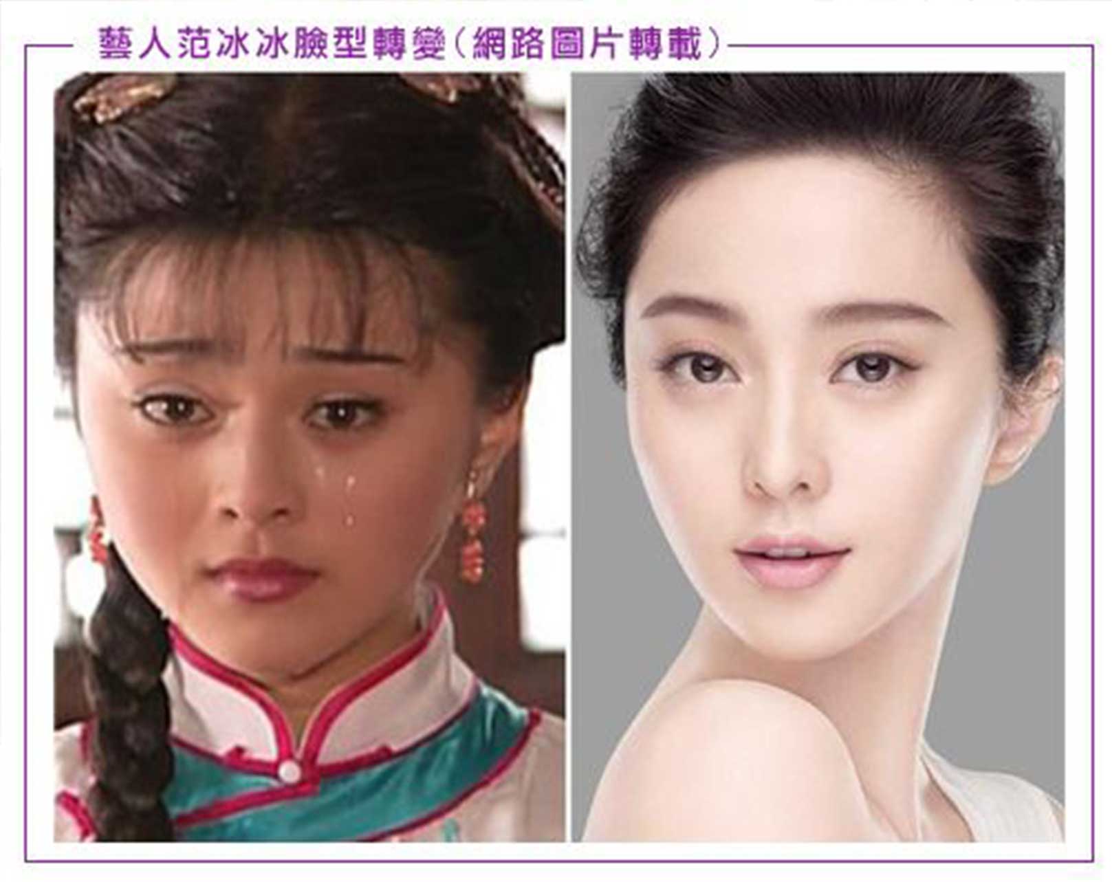 削骨,韓國削骨,上海削骨,磨骨,削骨手術,削骨十年,臉型雕塑,范冰冰,范爺,醫美,醫美日常