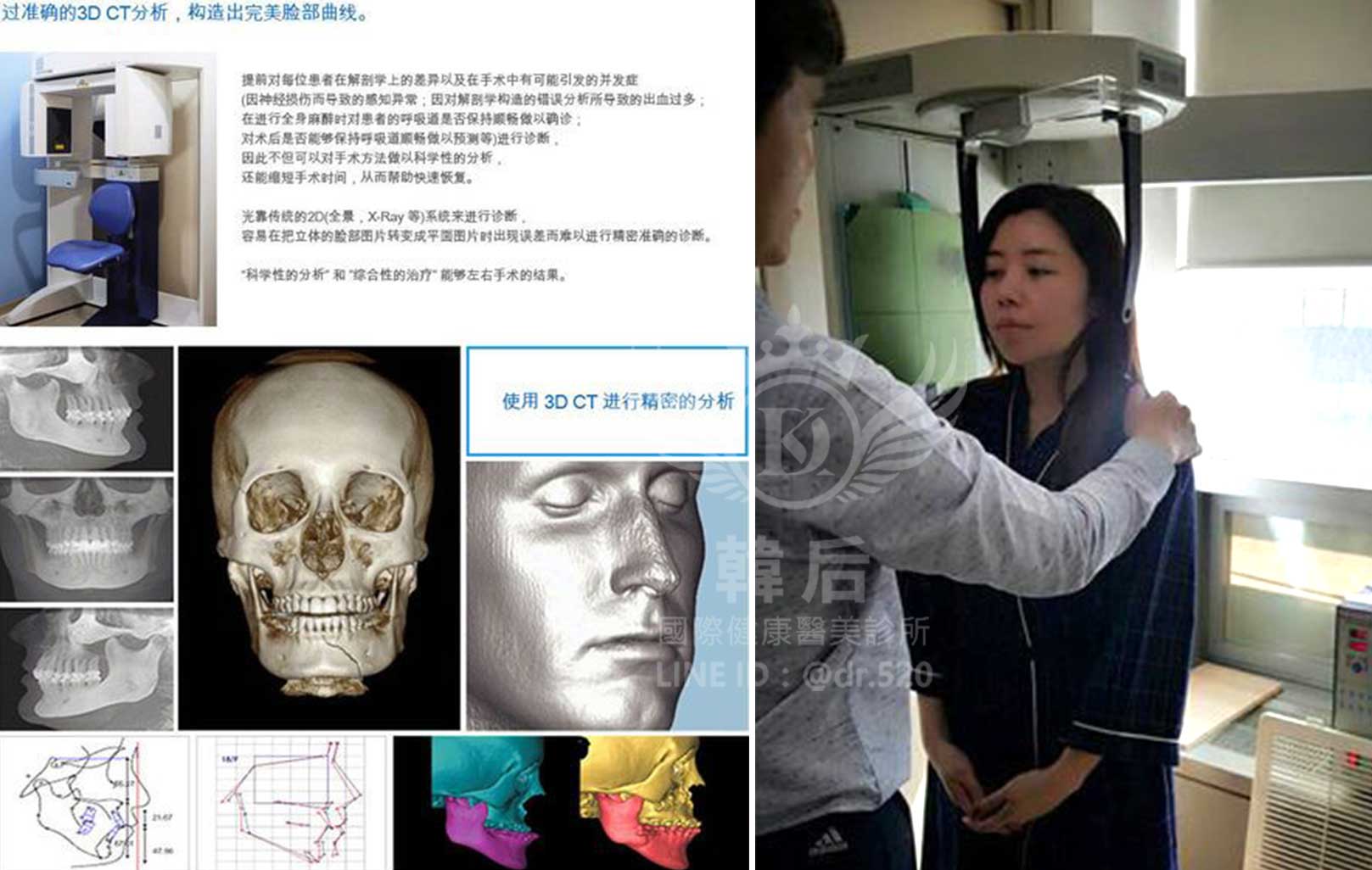 削骨,韓國削骨,上海削骨,磨骨,削骨手術,削骨十年,臉型雕塑,范冰冰,范爺,醫美,醫美日常
