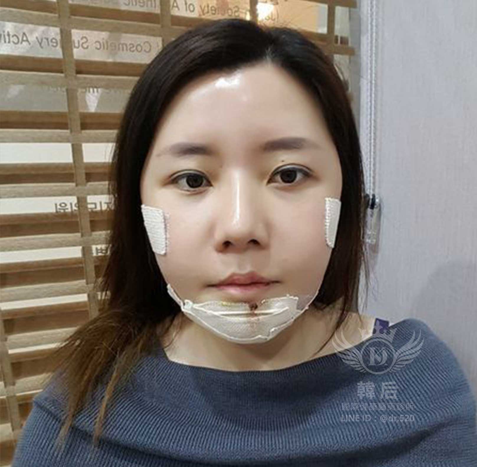 削骨,韓國削骨,上海削骨,磨骨,削骨手術,削骨十年,臉型雕塑,范冰冰,范爺,醫美,醫美日常