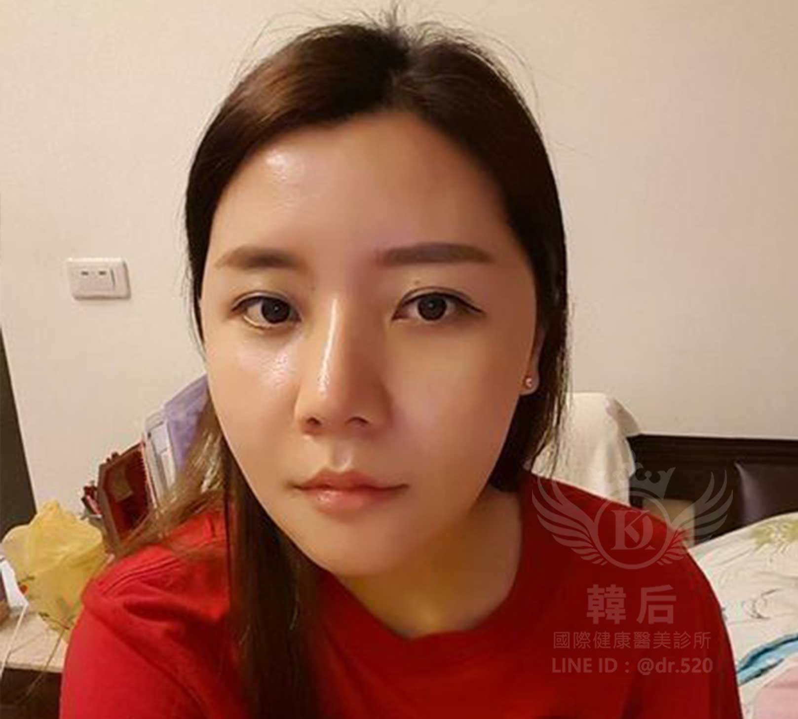 削骨,韓國削骨,上海削骨,磨骨,削骨手術,削骨十年,臉型雕塑,范冰冰,范爺,醫美,醫美日常