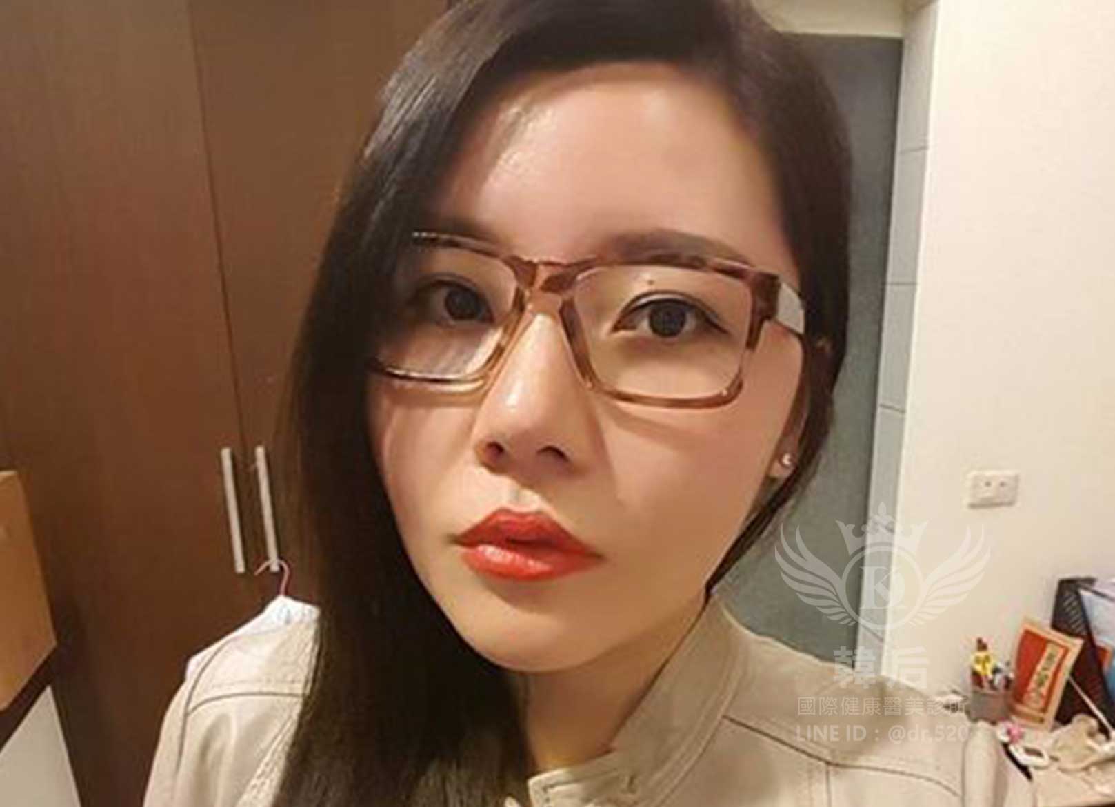 削骨,韓國削骨,上海削骨,磨骨,削骨手術,削骨十年,臉型雕塑,范冰冰,范爺,醫美,醫美日常