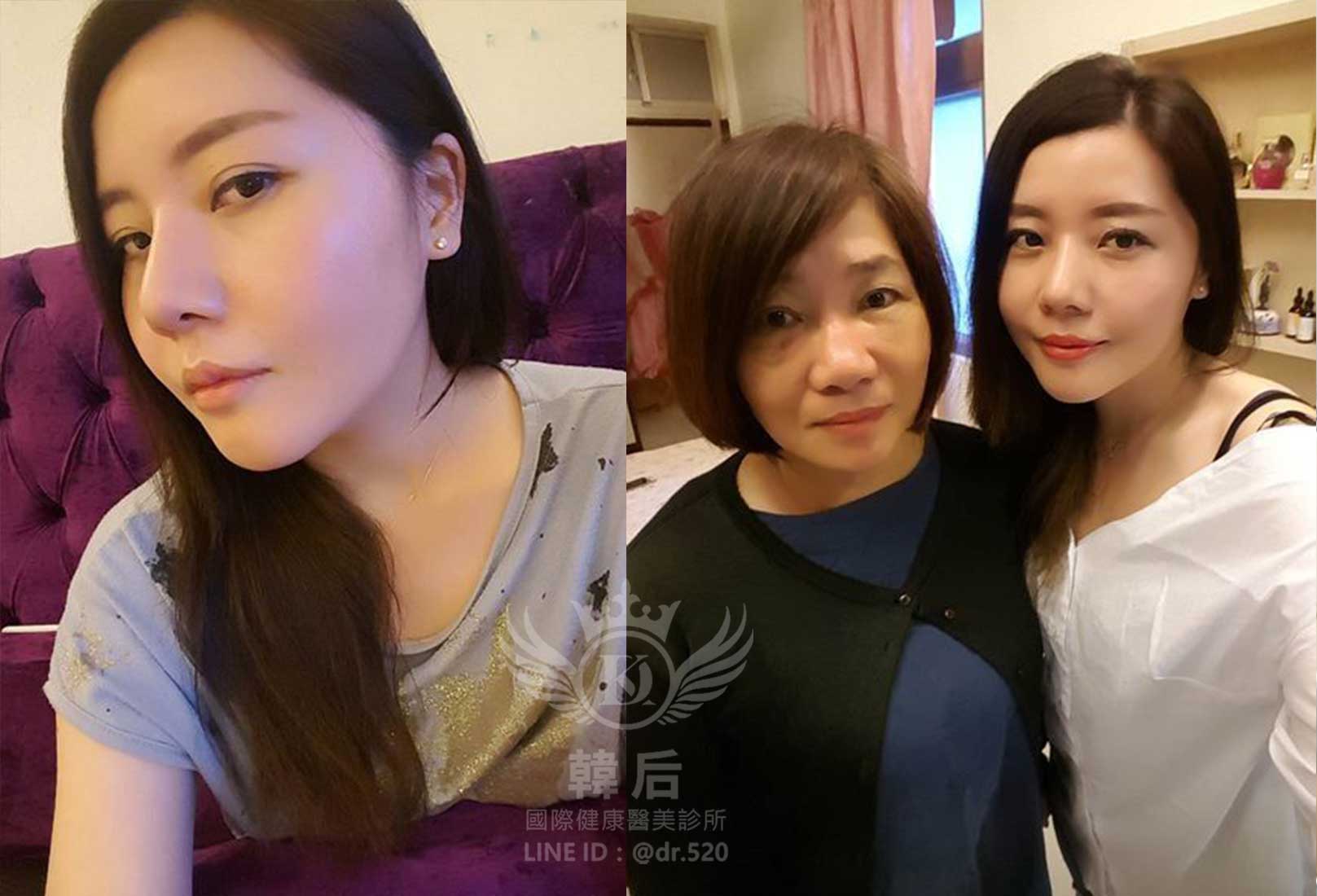 削骨,韓國削骨,上海削骨,磨骨,削骨手術,削骨十年,臉型雕塑,范冰冰,范爺,醫美,醫美日常