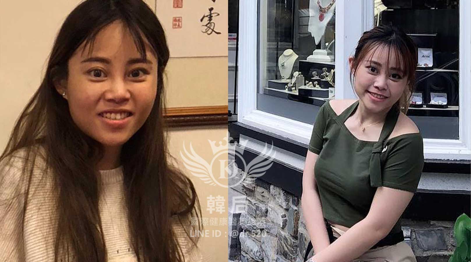 削骨,韓國削骨,上海削骨,磨骨,削骨手術,削骨十年,臉型雕塑,瘋狂小妞騏騏變美日記,騏騏,醫美,變美日記