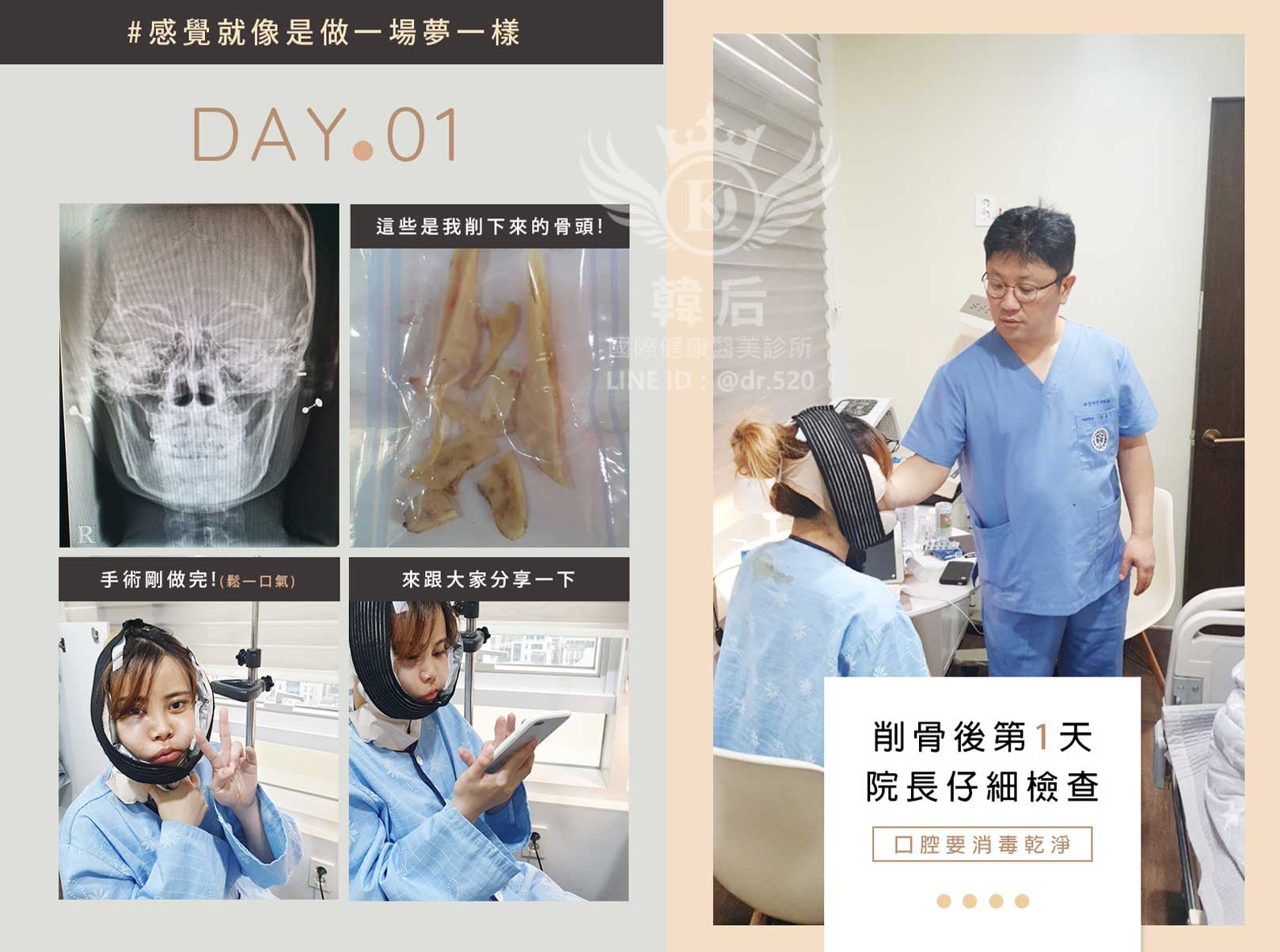 削骨後第一天,金一秀院長仔細檢查,口腔消毒乾淨,韓國削骨權威,削骨手術,金一秀院長,韓國削骨,磨骨,諮詢,面診,臉型雕塑,瘋狂小妞騏騏變美日記,騏騏,醫美,變美日記