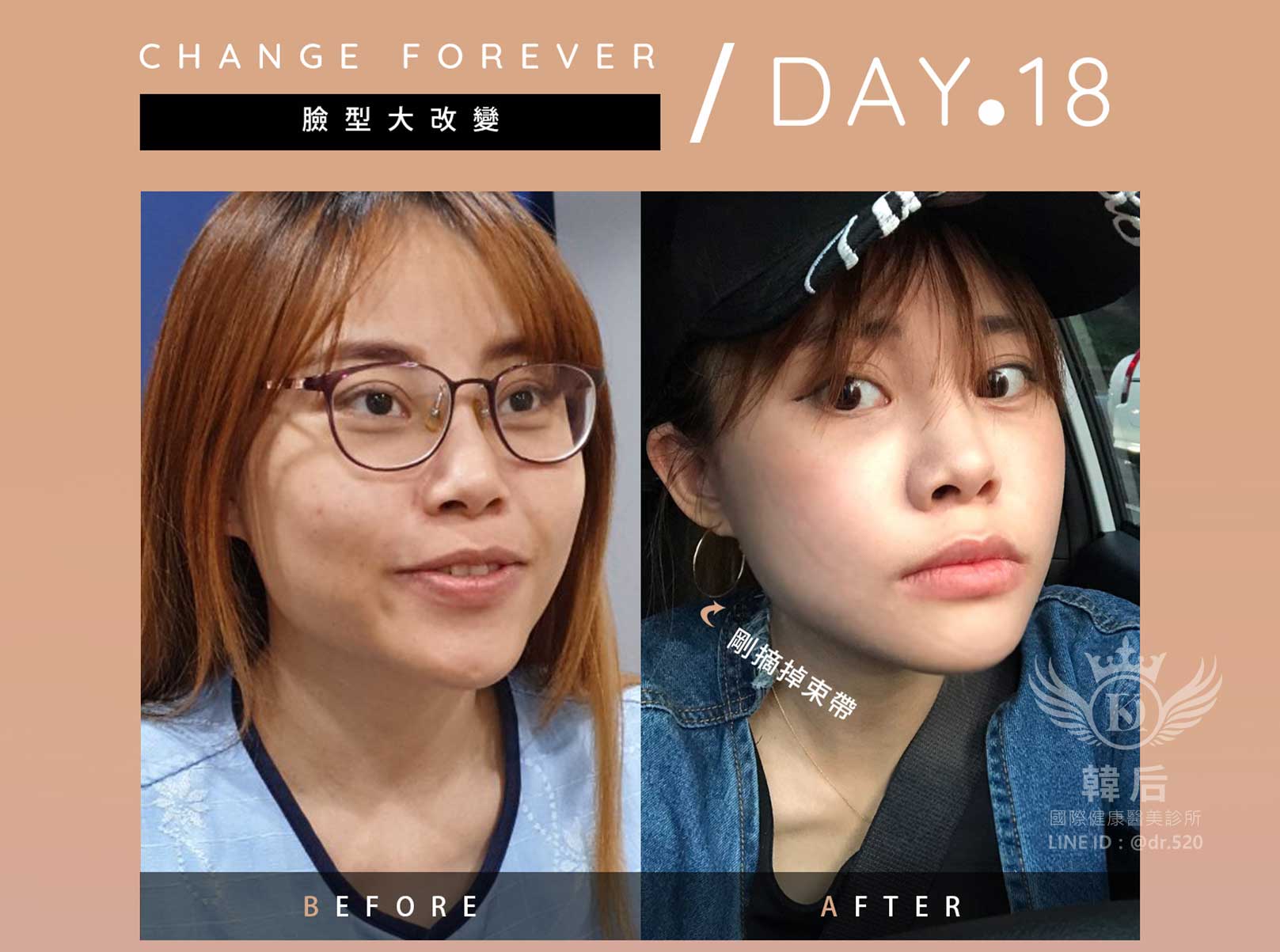削骨後第18天，剛摘掉束帶~腫脹度明顯降低、臉型超順暢是瓜子臉、小V臉耶~韓國削骨權威,削骨手術,金一秀院長,韓國削骨,磨骨,臉型雕塑,瘋狂小妞騏騏變美日記,騏騏,醫美,變美日記