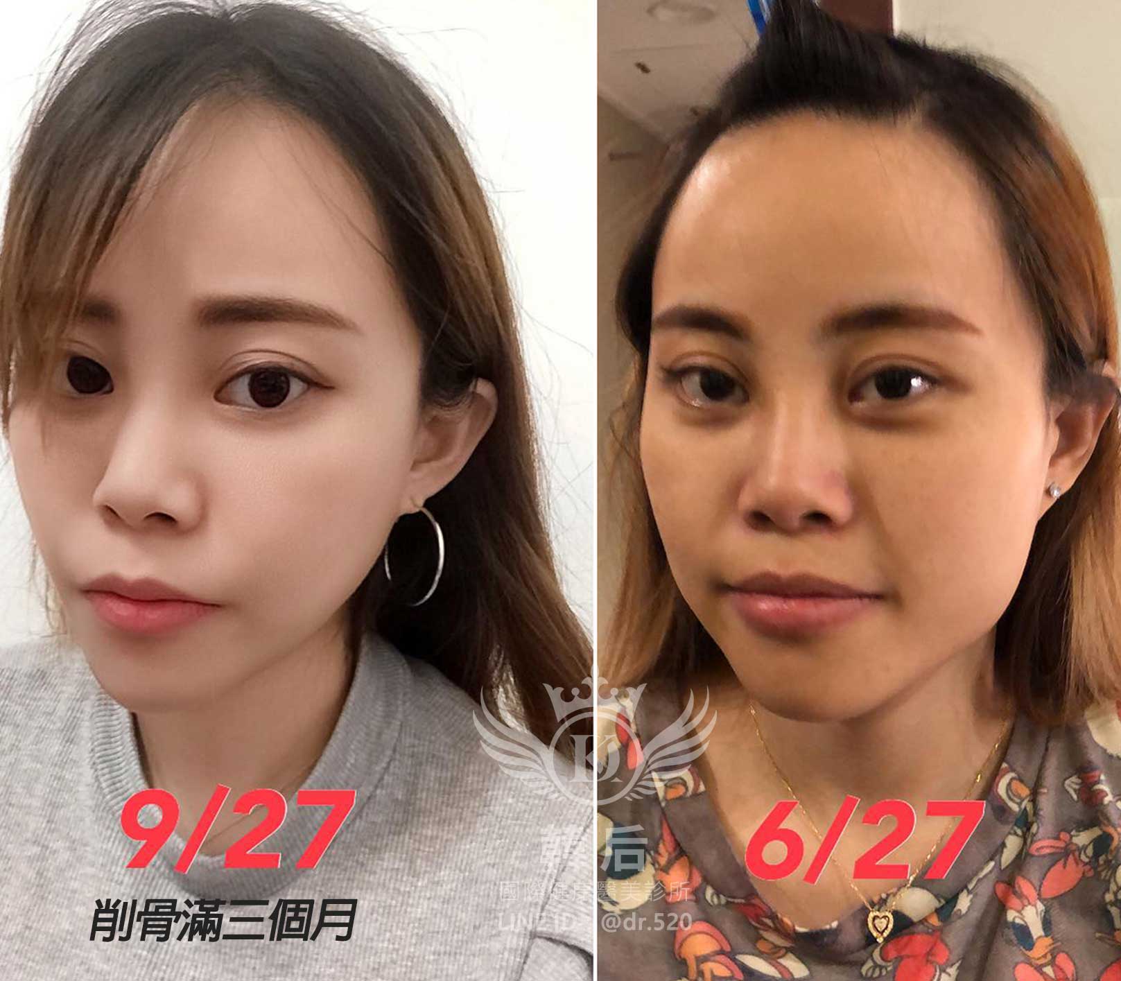 削骨後滿三個月,韓國削骨權威,削骨手術,金一秀院長,韓國削骨,磨骨,臉型雕塑,瘋狂小妞騏騏變美日記,騏騏,醫美,變美日記