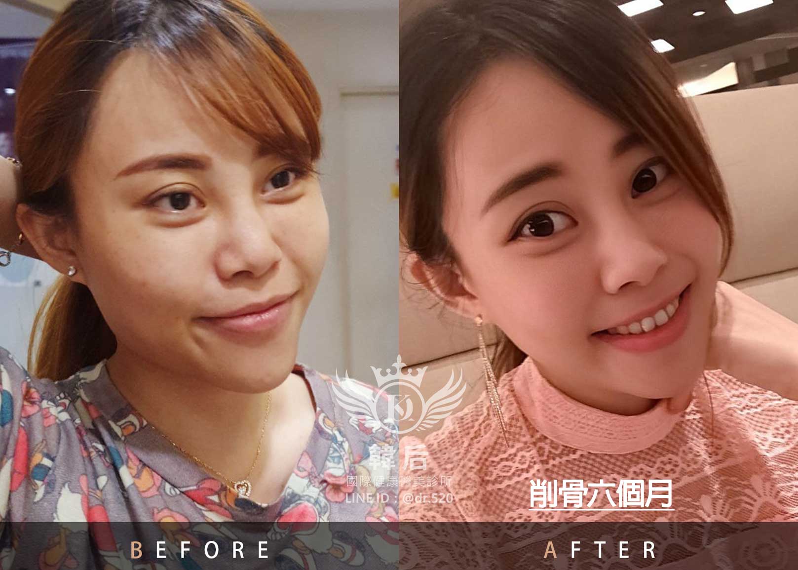削骨後六個月,韓國削骨權威,削骨手術,金一秀院長,韓國削骨,磨骨,臉型雕塑,瘋狂小妞騏騏變美日記,騏騏,醫美,變美日記
