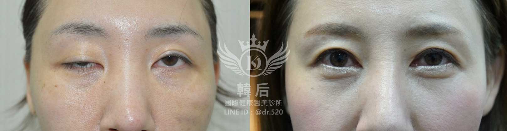 韓后醫美,雙眼皮重修,韓國,上海,台灣,整形修復專科,素人真實案例
