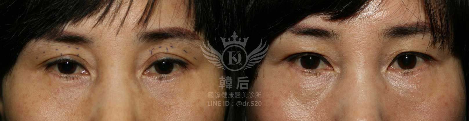 韓后醫美,雙眼皮重修,韓國,上海,台灣,整形修復專科,素人真實案例