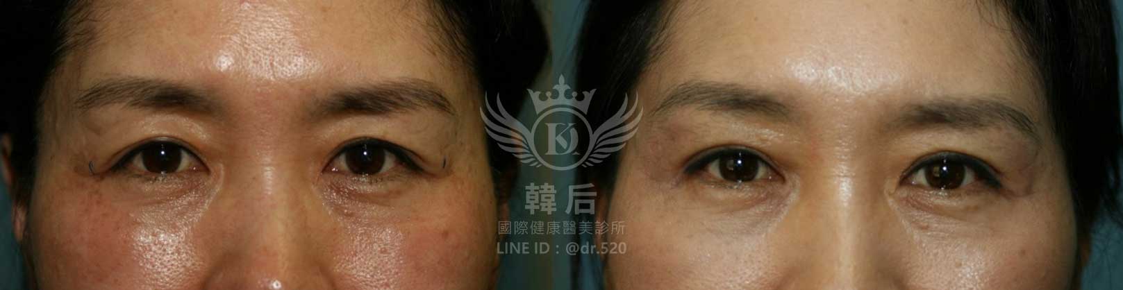 韓后醫美,雙眼皮重修,韓國,上海,台灣,整形修復專科,素人真實案例