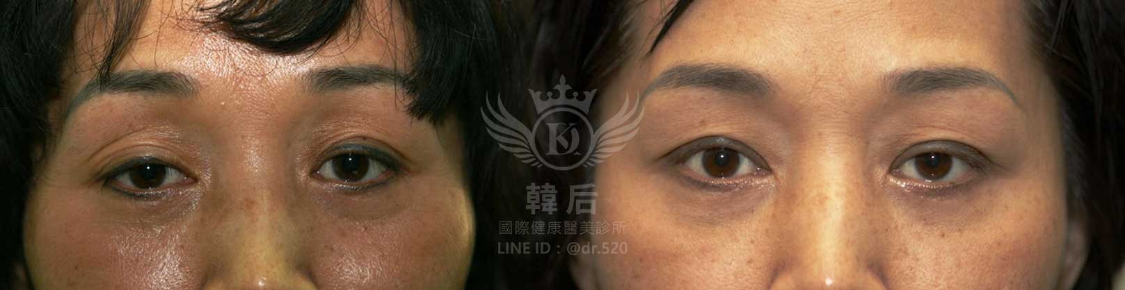 韓后醫美,雙眼皮重修,韓國,上海,台灣,整形修復專科,素人真實案例