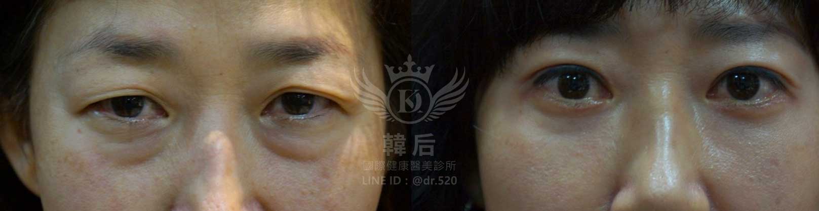 韓后醫美,雙眼皮重修,韓國,上海,台灣,整形修復專科,素人真實案例