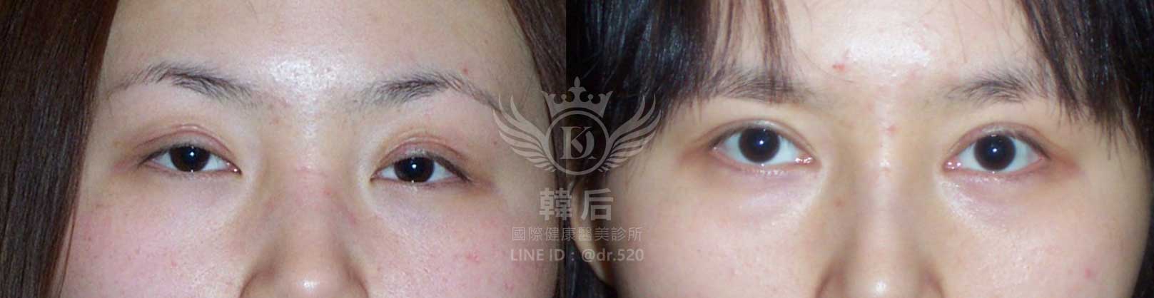 韓后醫美,雙眼皮重修,韓國,上海,台灣,整形修復專科,素人真實案例